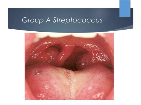 Acute pharyngitis | PPT