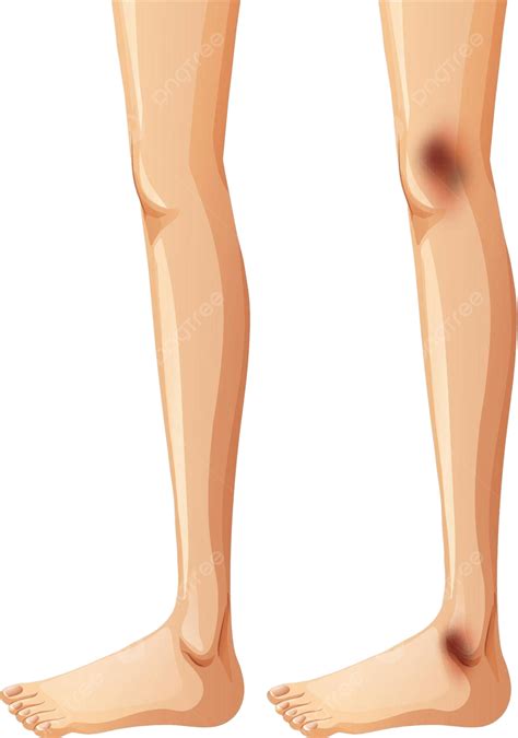 Human Legs And Bruise On White Background Ache People Background Vector ...