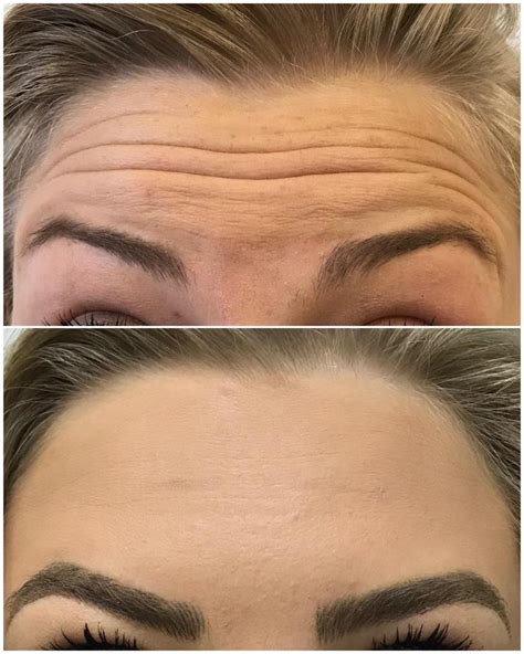 Anti-Wrinkle Treatment – Murton Dental Practice
