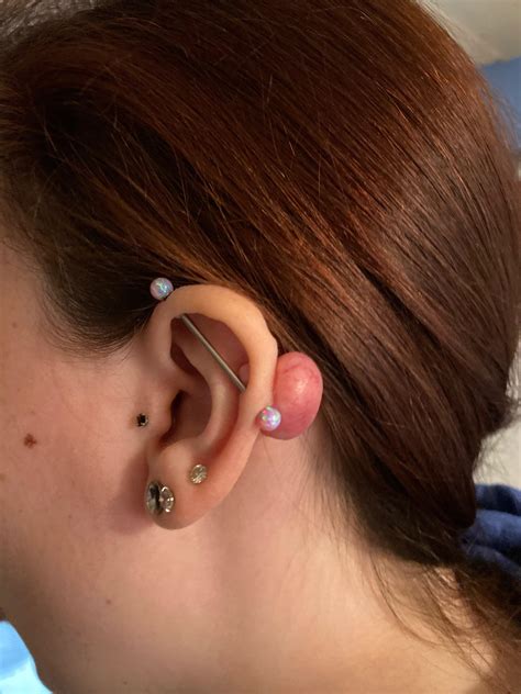 how to get rid of keloid nose piercing 6