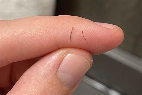 Understanding Hair Splinters: Causes, Symptoms and How to Prevent Them