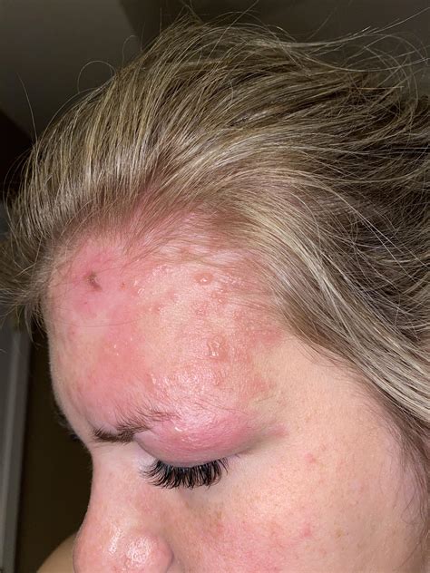 Day 5 of face shingles and day three of antiviral meds. Please tell me