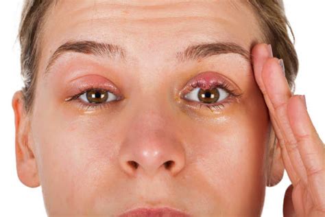 eyelid swollen symptoms  treatment