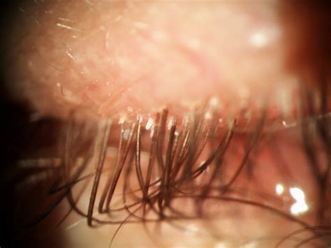Demodex Eyelash Mites