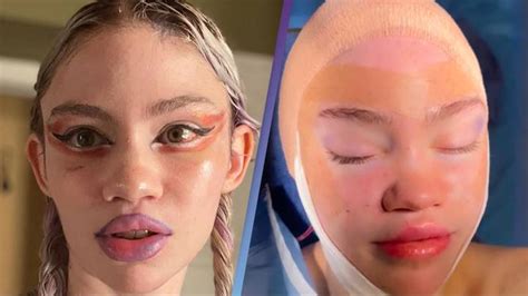 Grimes posts selfie for the first time after surgery and fans seem