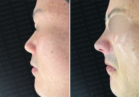 Short and Upturned Nose Correction – A Comprehensive Guide to Natural ...