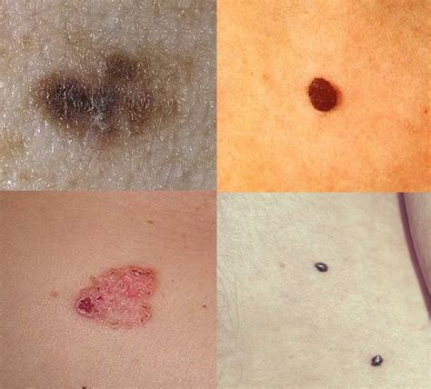 Как выглядит меланома фотографии