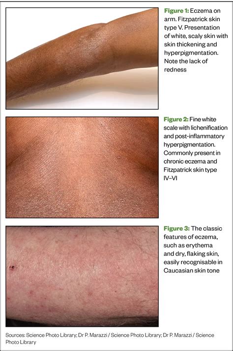 Dusky Skin Color Medical