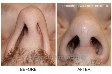 fixing  deviated septum change  shape   nose