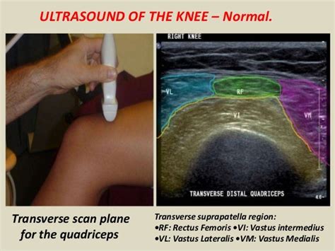 Presentation1.pptx, ultrasound examination of the knee joint.