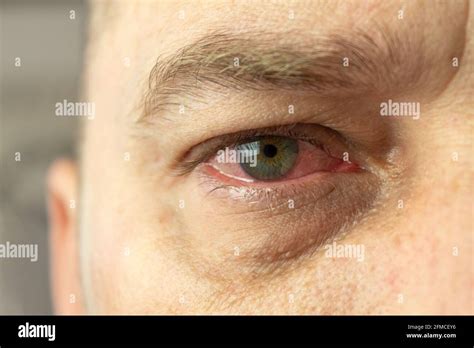 Red and inflamed eye close-up. Patient's red eye. Allergic reaction ...