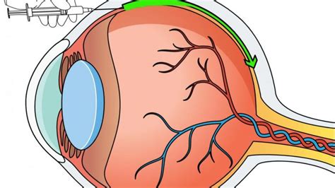 Gene Therapy Improves Eye Function in Patients