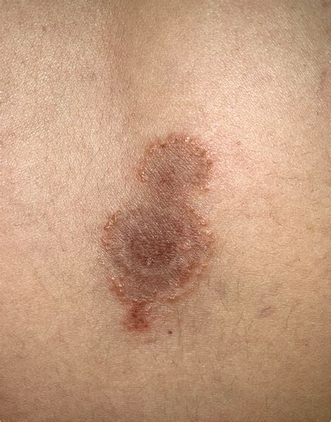 Annular papulovesicular lesions with a purpuric center in a female