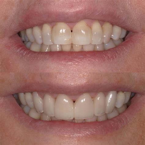 Dentist Before After Gallery, Family and Cosmetic Dentistry in 11378