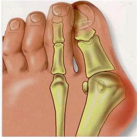 2 זוג ג 'ל מפריד בוהן Valgus פיקה מתקן מדרסי אגודל עצם רגליים עיסוי ...