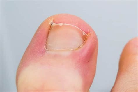 14 Natural Remedies For Ingrown Toenail (At Home) - OptingHealth