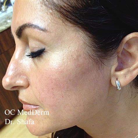 Skin Discoloration Treatment Orange City | Irvine Skin