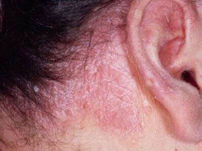 Себорея и себорейные процессы | Medic Hair