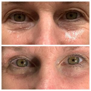 Non-Surgical Eye Lift - Hush Medical Aesthetics