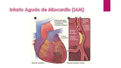 CASO CLÍNICO INFARTO AGUDO AL MIOCARDIO | Infarto agudo de miocardio ...