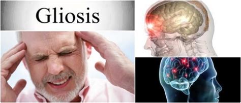 Gliosis: ¿Que es? Aprende A Detectar A Tiempo Esta Enfermedad – Causas, Síntomas y Tratamiento ...