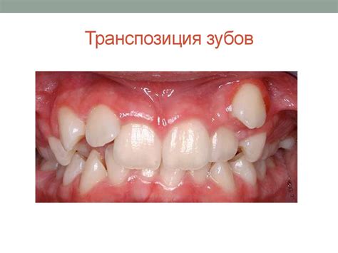 Прикусы. Виды патологических прикусов - презентация онлайн