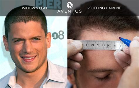 receding hairline  caused    fix  aventus clinic