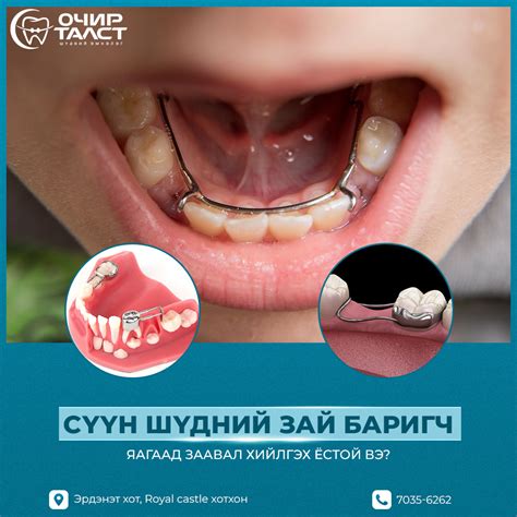 Сүүн шүдний зай баригч Цоорлын... - Очир талст шүдний эмнэлэг