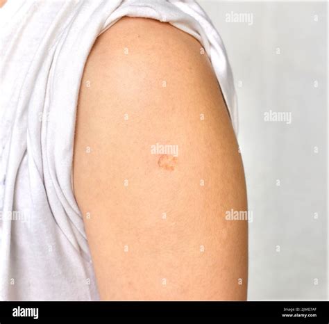 vaccination mark  res stock photography  images alamy