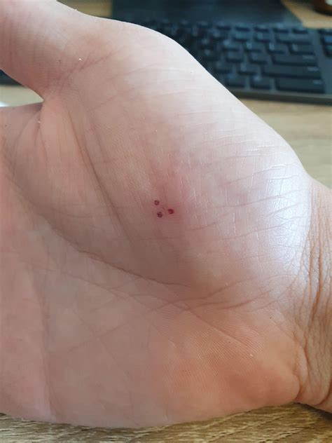 My dog got overexcited and nipped me when we were playing tug of war