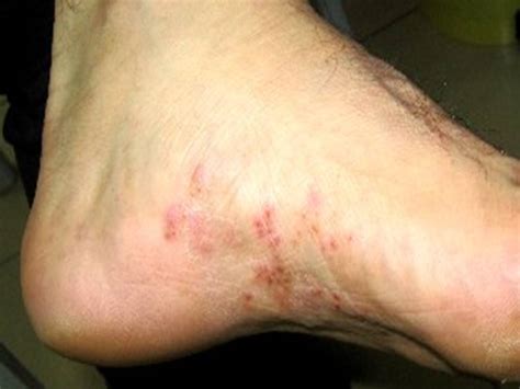 Tinea Pedis Athletes Foot Causes Symptoms Treatment Images