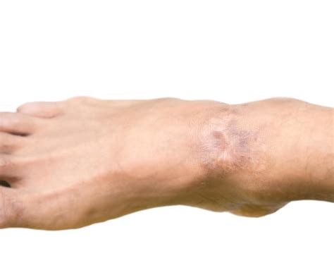 Keloid scar on ankle skin. Hypertrophic scar treatment by laser and