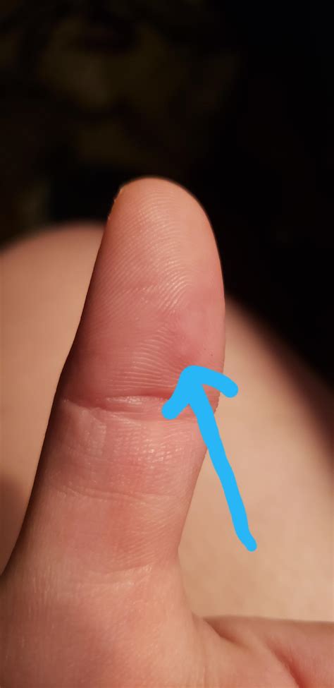 Small painful bump on finger under skin - plzmint