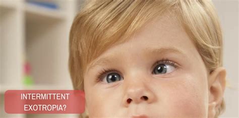 How is intermittent exotropia treated?