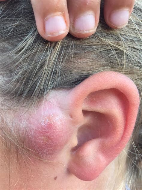 Boil On Ear: Causes, Symptoms, And Treatment, 48% OFF