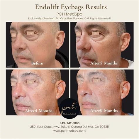 Endolift Los Angeles, CA - Best Facelift laser | PCH MedSpa