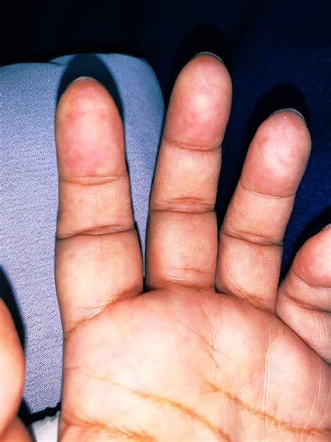 Lesiones De Janeway Endocarditis On X: "Otros Síntomas Relacionados