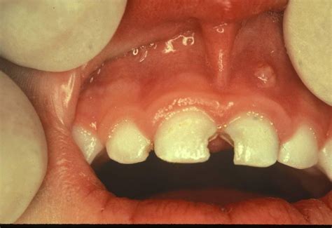 fill cavities  baby teeth mannerpic