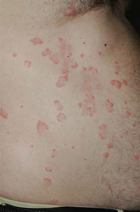 Urticarial Vasculitis Diagnosis Of Cutaneous Vasculitis | GPonline