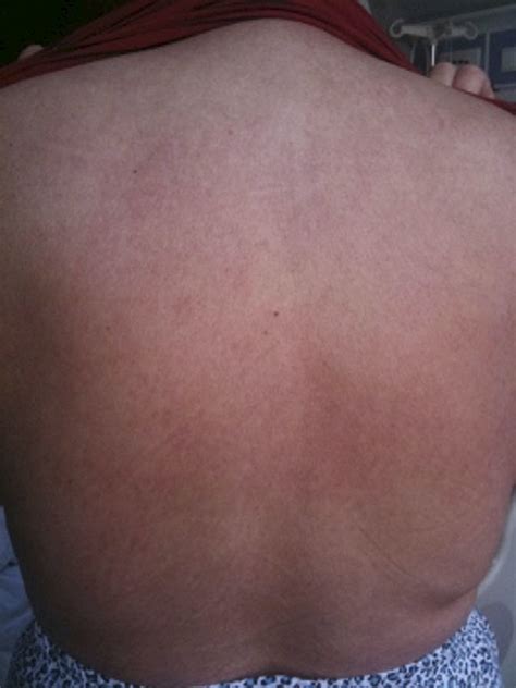 figureerythematous skin rash     scientific diagram