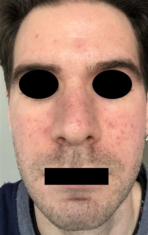 acne rosacea rosacea facial redness acneorg forum
