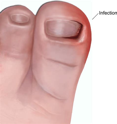 Surgery for ingrowing toenail (child) | healthdirect