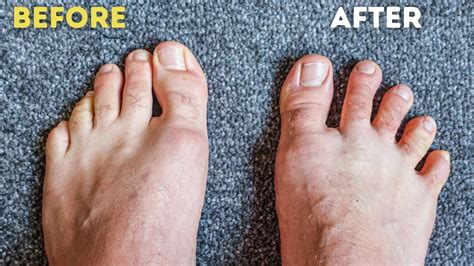 What are toe spacers? – “life saver” Used for? – HappyWalk - Orthopedic ...