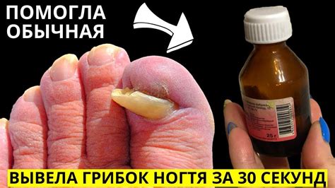 От ГРИБКА НОГТЕЙ можно Избавиться за 30 СЕКУНД простым... Это точно ...