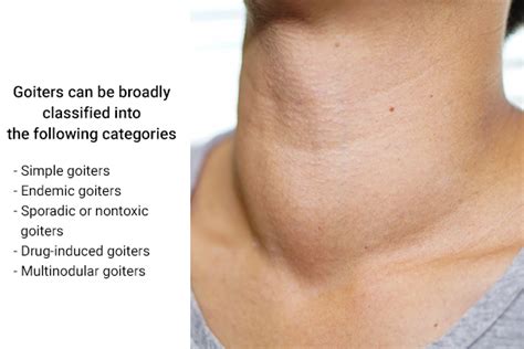 thyroid goiter  goiter  treatment types  symptoms