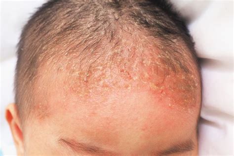 What is Seborrheic Dermatitis? Symptoms and Treatments - Facty Health