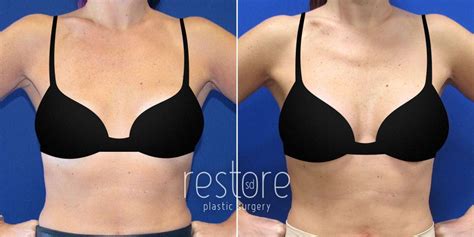 Breast Implant Revision San Diego - Dr. Katerina Gallus offers breast ...