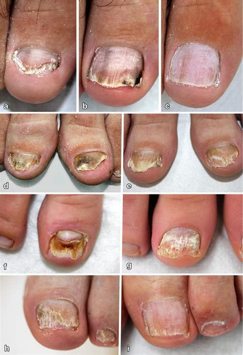 Treatment of onychomycosis using a 1064-nm diode laser with or without