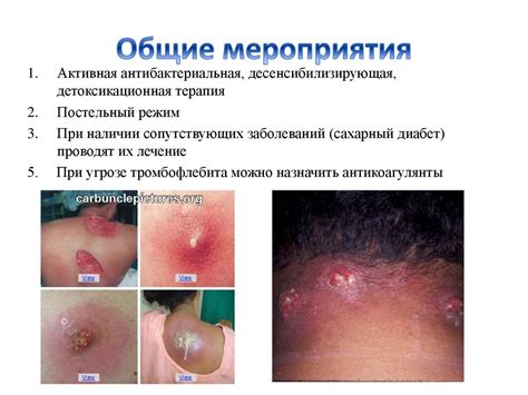 Фурункулы и карбункулы лица - презентация онлайн
