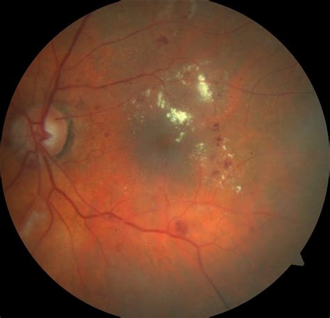 DIABETIC RETINOPATHY Classification Dataset and Pre-Trained Model by ...